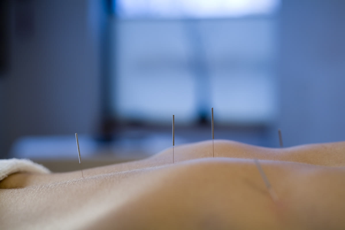 Close-up: hands inserting a fine acupuncture needle on the upper back