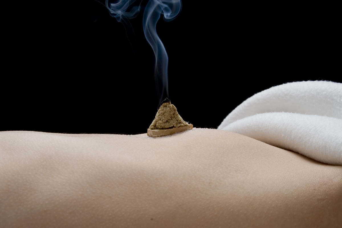 Glowing moxa stick held over a back with acupuncture needles in place
