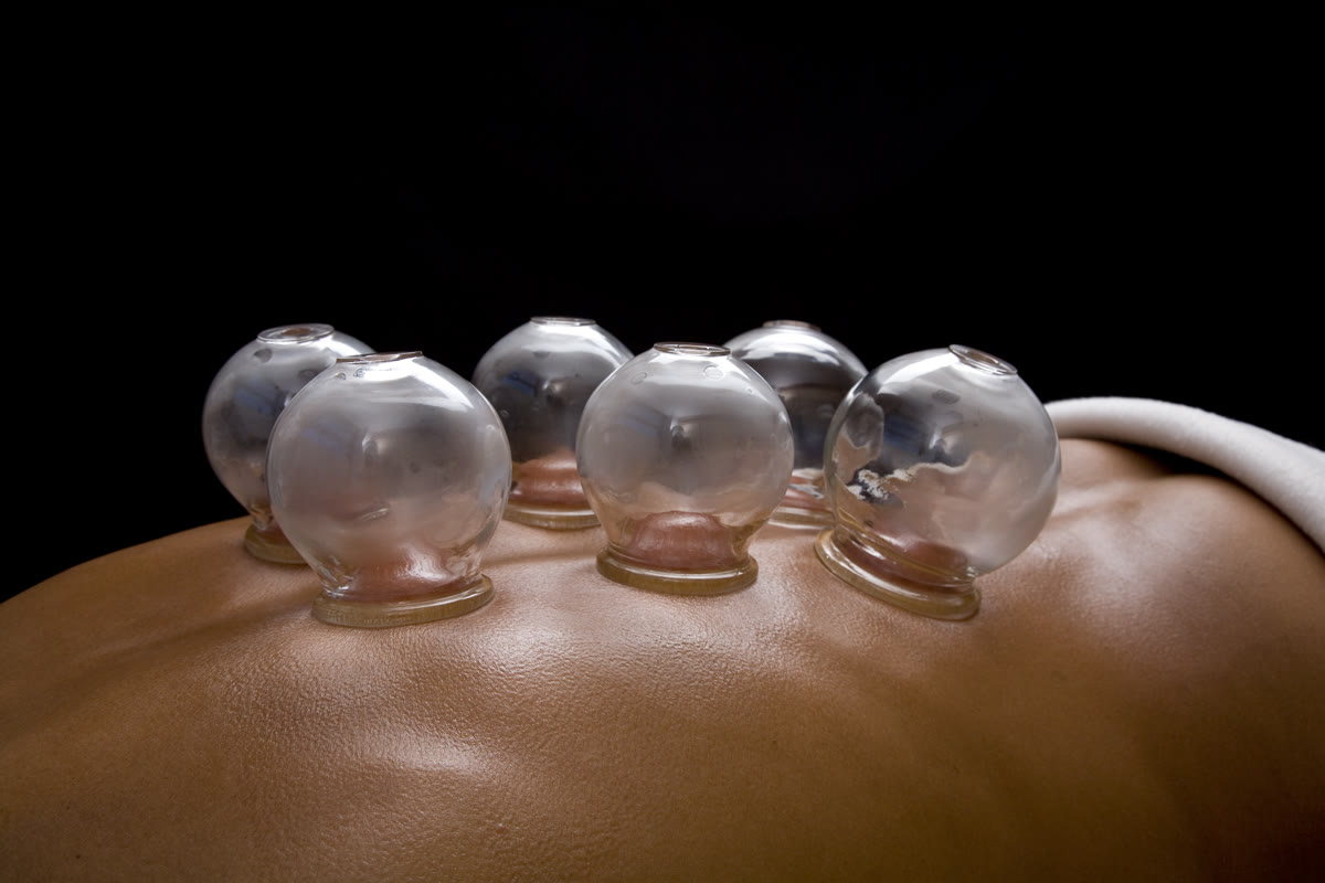 Close-up: four cupping cups on a person's back